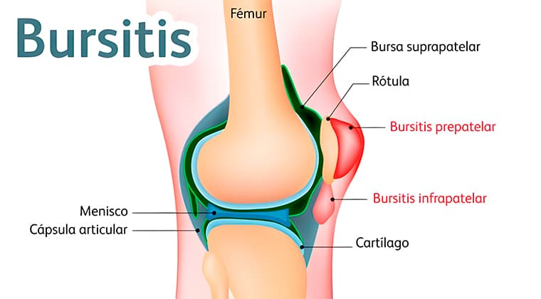 Bursitis