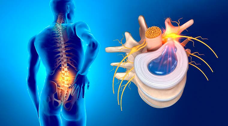 Hernias Discales