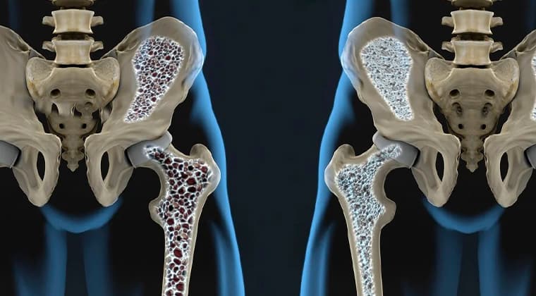 Osteoporosis con Fracturas por Fragilidad
