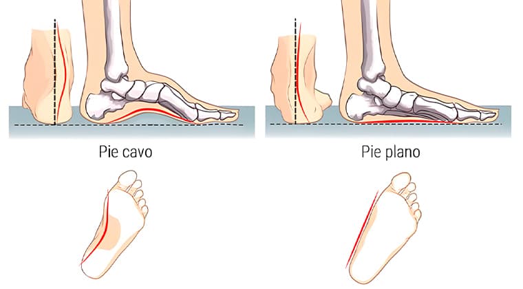 Pie Plano o Pie Cavo