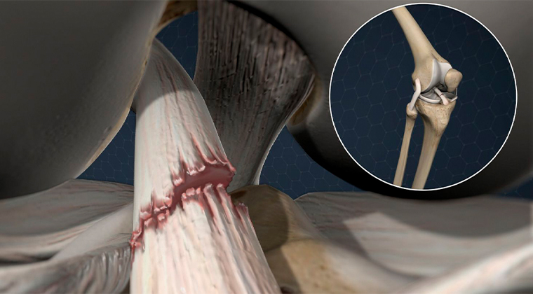 Lesiones de Ligamentos