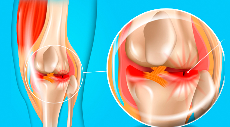 Lesiones Meniscales