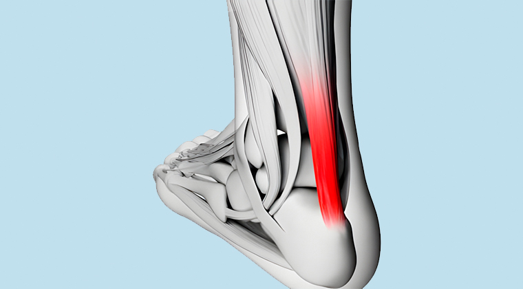 Tendinitis