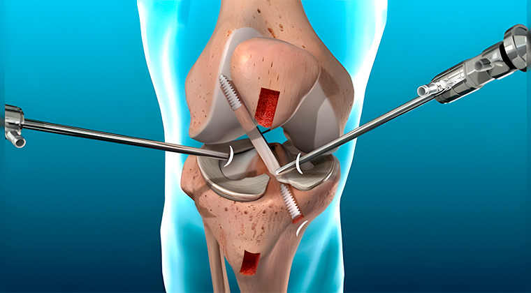 Artroscopia de Rodilla