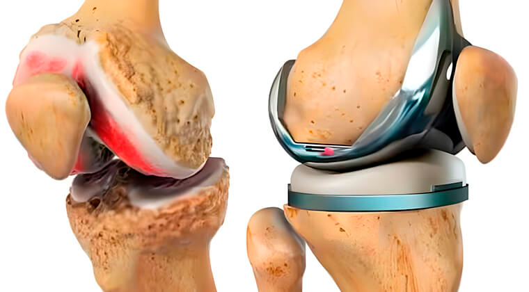 Prótesis de Rodilla